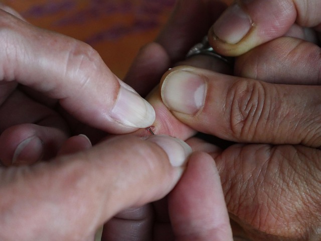 a splinter in a finger